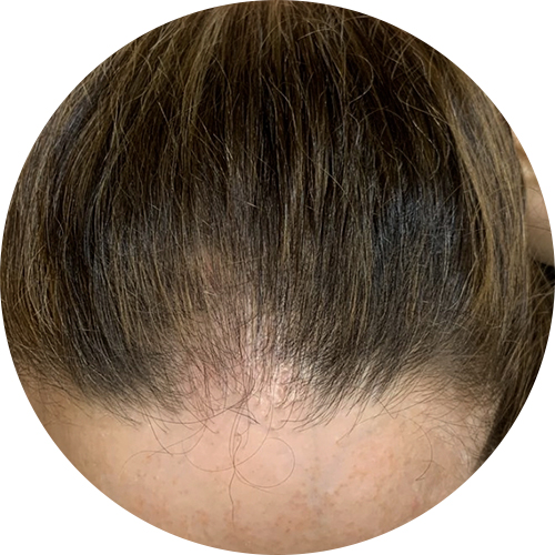 alopecia fibrosante<br> frontal